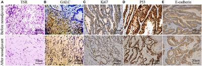 GALC Triggers Tumorigenicity of Colorectal Cancer via Senescent Fibroblasts